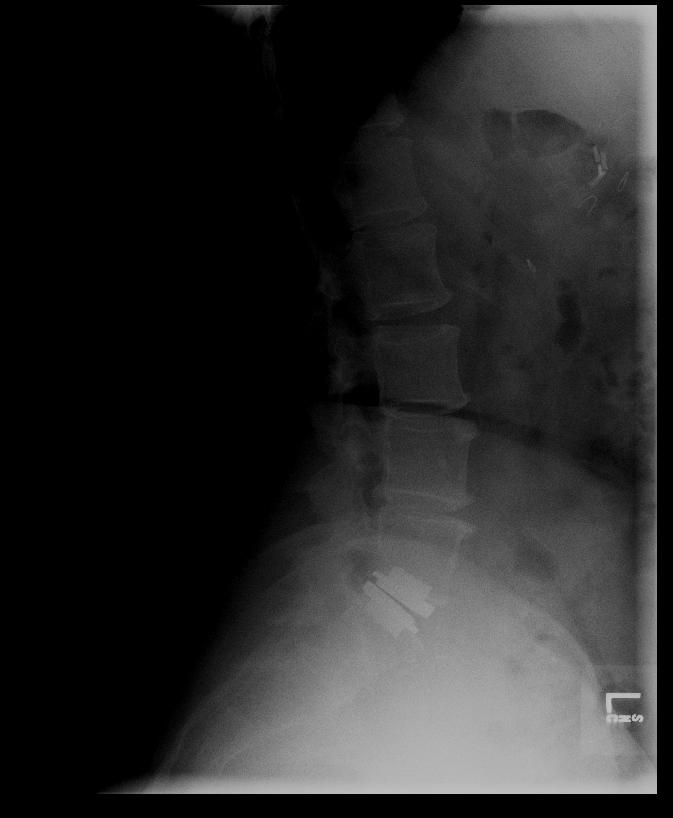 prodisc oklahoma spine surgeon